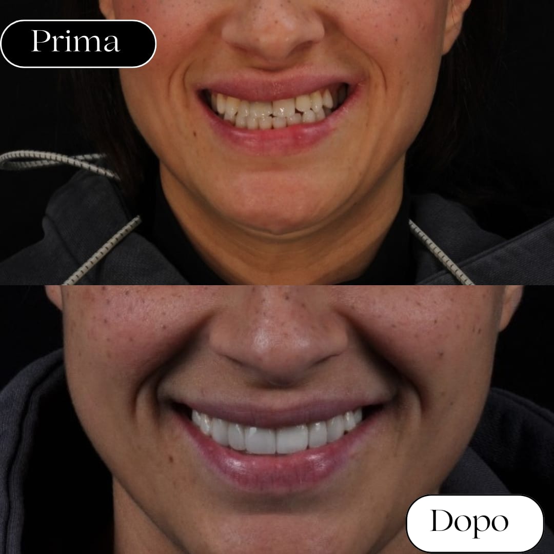 faccette dentali rizzuto