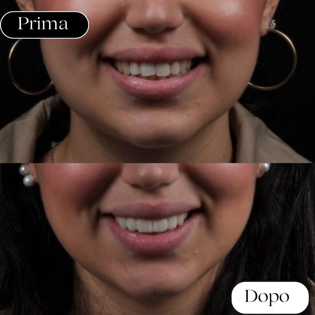 faccette dentali rizzuto